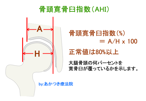 骨頭寛骨臼指数（AHI）