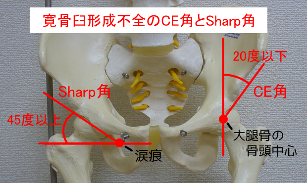 寛骨臼形成不全のCE角とSharp角