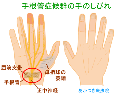 手根管症候群の手のしびれ イラスト