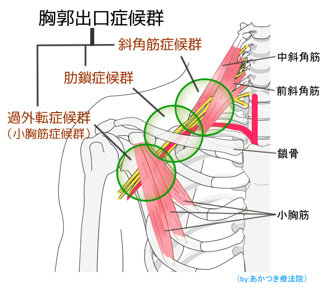 胸郭出口症候群の解剖図