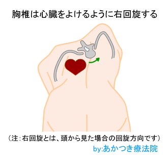 特発性側弯症の胸椎の右回旋